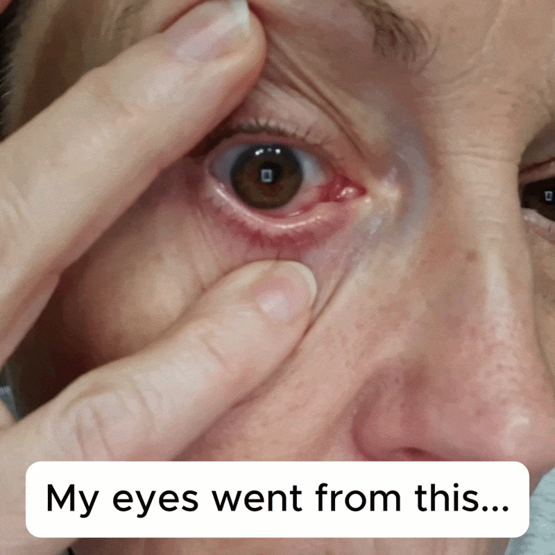 Dry eye relief animation